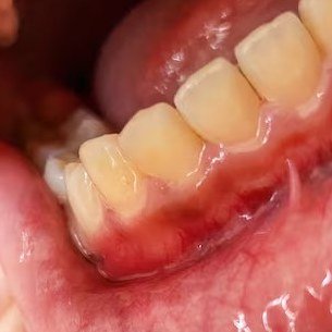 Gengiva inflamada e avermelhada na base dos dentes